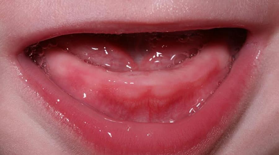 Прорезывание, рост зубов и зубные боли у ребенка. Прорезывание зубов у детей