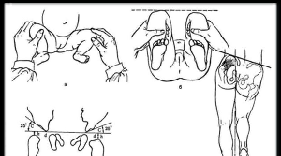 Массаж тазобедренного суставов ребенку. Дисплазия тазобедренных суставов у детей ЛФК. Дисплазия тазобедренных суставов операция. Схема ТБС дисплазия. ЛФК при дисплазии тазобедренных суставов.