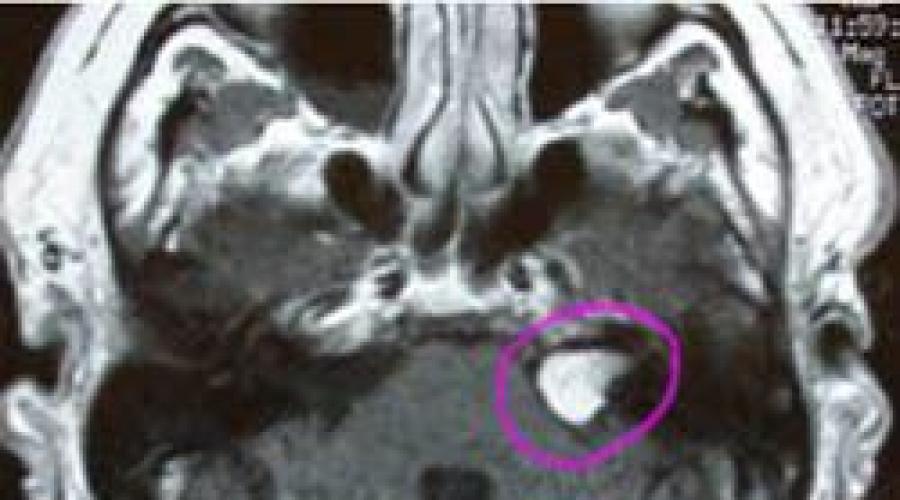 Невринома слухового нерва презентация