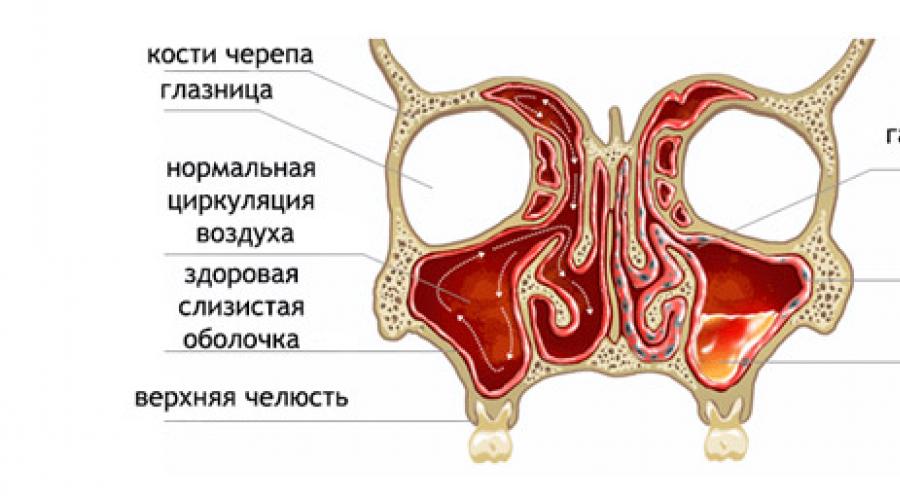 Стенки пазух. Соустье гайморовой пазухи анатомия. Верхнечелюстная пазуха анатомия строение.