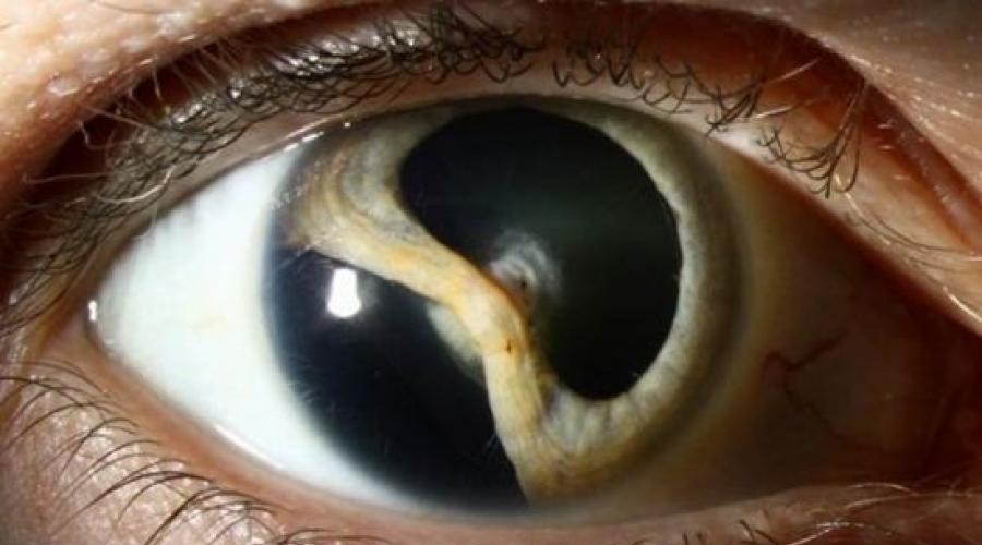Колобома глаза: причины, симптомы и лечение заболевания. Что такое колобома хрусталика глаза, ее причины возникновения и лечение Влияет ли колобома на зрение