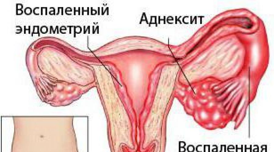 Симптомы воспаления яичников у женщин. Сальпингит и сальпингоофорит. Гонорейный сальпингит.