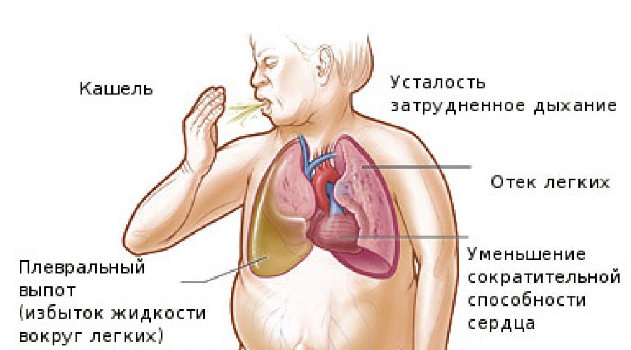 Сердечный отек картинка