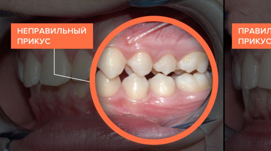 Как самому выровнять зубы. Как выровнять зубы без брекетов у детей и взрослых? Применение трейнеров с целью выравнивания зубных рядов