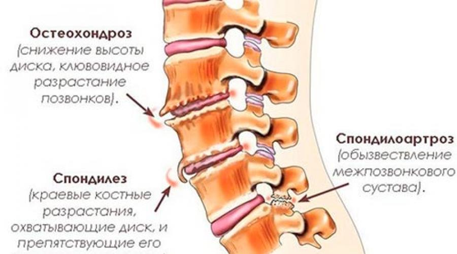 Дегенеративно дистрофические изменения позвоночника что это. Дегенеративно-дистрофические изменения позвоночника. Остеохондроз спондилоартроз. Спондилоартроз пояснично-крестцового отдела позвоночника корсет.