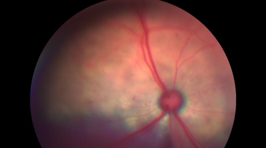 Что такое атрофия сетчатки глаза — причины и лечения. Коварное заболевание атрофия сетчатки у собак: есть ли шанс избежать слепоты