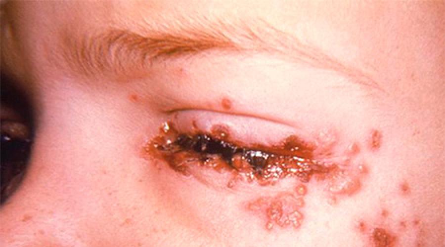 Офтальмогерпес или герпес на глазах: как проявляется и правильно лечится? Что такое герпес глаз и как его быстро вылечить? Герпесвирусная простуда на глазу. 