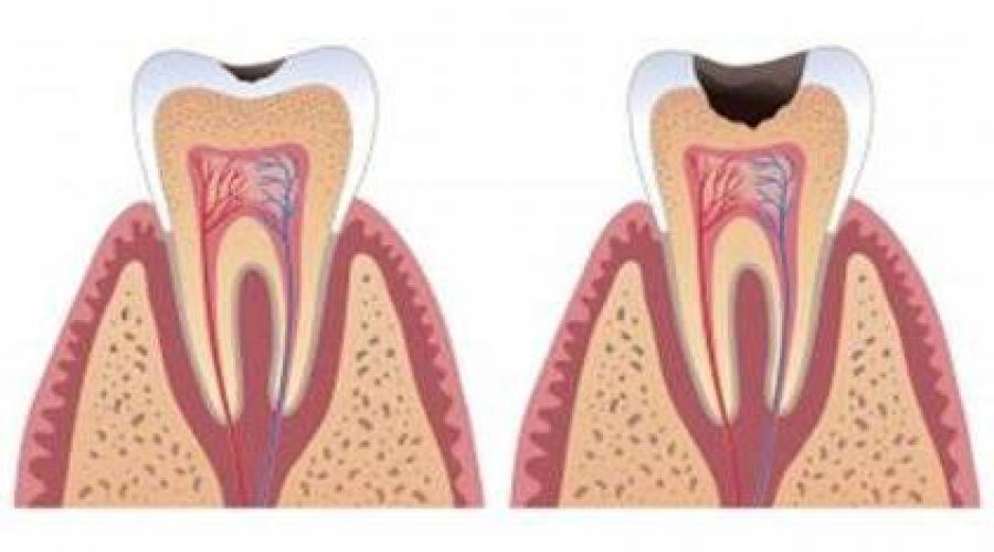 Пульпит зуба – симптомы и лечение. Пульпит: классификация, причины, симптомы и лечение Что такое пульпит и как его лечить