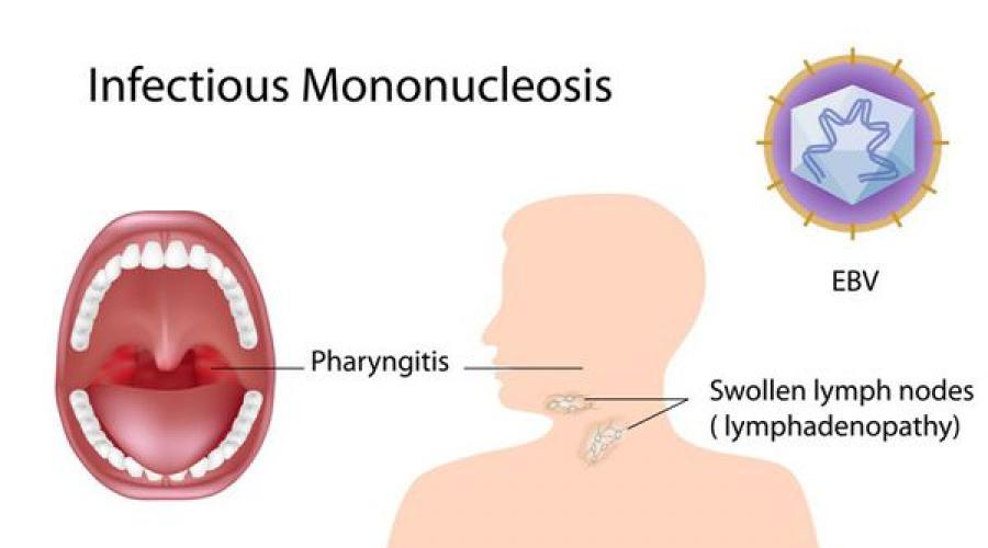 Мононуклеоз у детей что это. Инфекционный мононуклеоз гепатоспленомегалия. Инфекционный мононуклеоз мрт. Инфографика мононуклеоз.