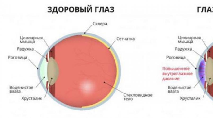 Глаукома и контактные линзы. Контактные линзы и глаукома Режим труда и отдыха
