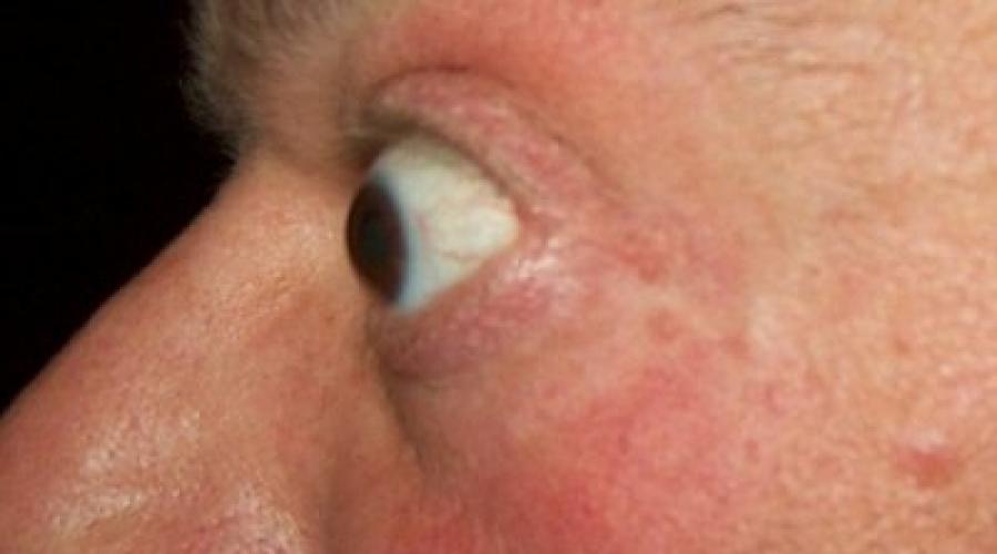 Болезнь выпуклых глаз. Основные причины и способы лечения экзофтальма