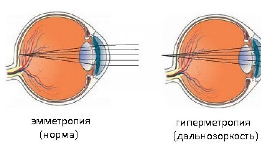 Клинические аномалии рефракции глаза: что это такое, основные виды патологии, рефракционное лечение и коррекция зрения. Рефракция зрения Причины возникновения рефракционных ошибок