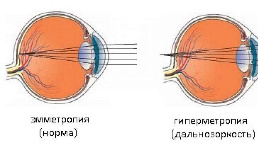 Рефракция эмметропия. Рефракция миопия и гиперметропия. Рефракция глаза. Виды клинической рефракции глаза. Эмметропия глаза что это такое.