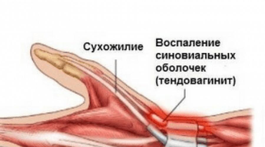 Сухожилия кисти руки фото