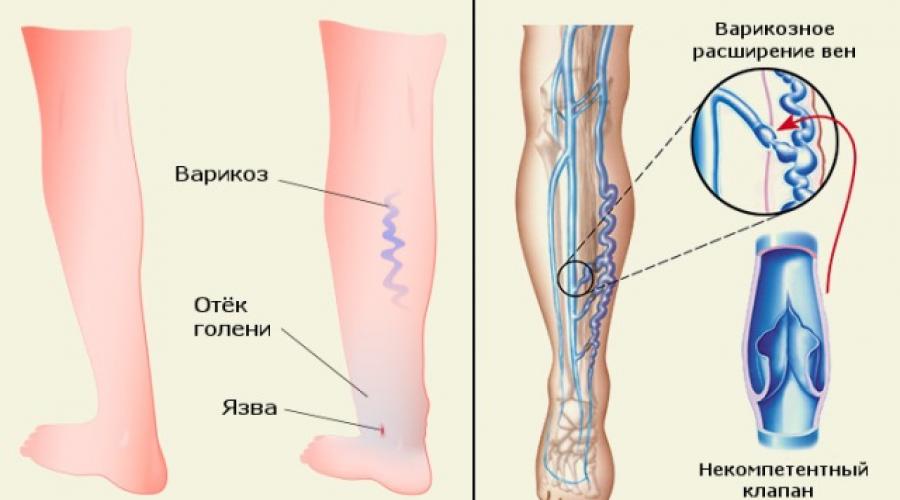 Перечень возможных осложнений из-за варикоза сосудов ног. Варикозное расширение вен (варикоз)