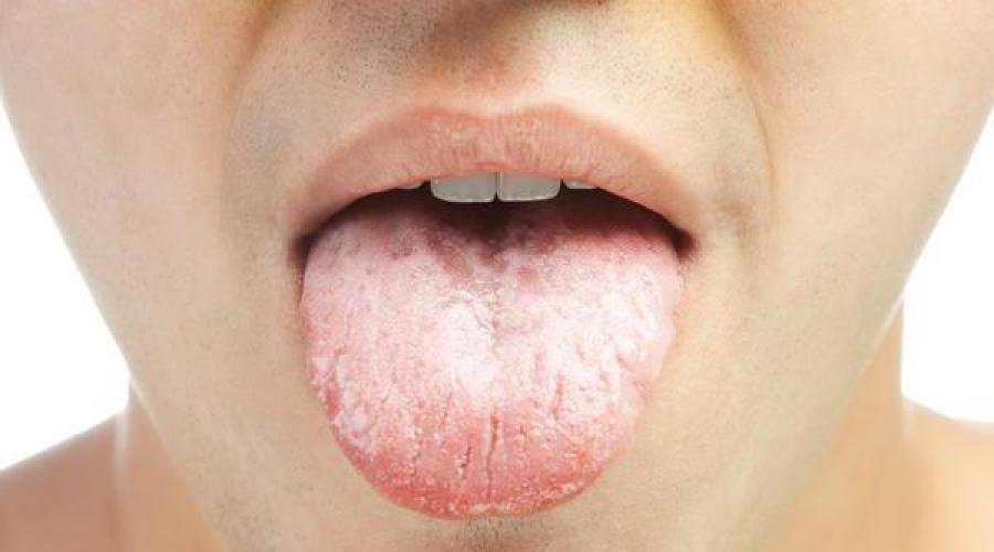 От чего может распухнуть язык. Макроглоссия (увеличенный язык): симптомы и методы лечения