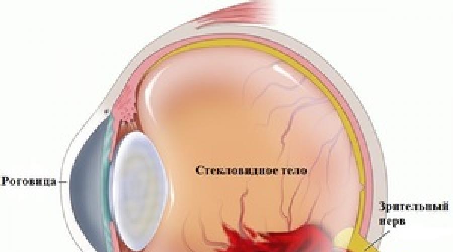 Кровоизлияние на глазном яблоке. Основные причины и лечение кровоизлияния в глаз