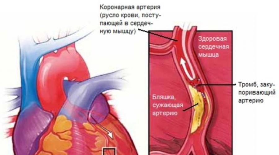 Острый инфаркт миокарда — причины появления и виды патологии. Инфаркт миокарда: причины, первые признаки, помощь, терапия, реабилитация