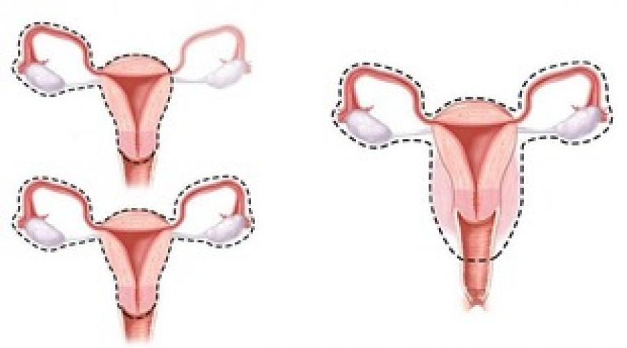 Лечение рака шейки матки на разных стадиях. Излечим ли рак шейки матки