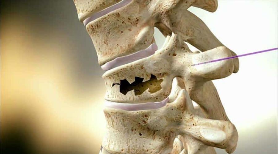  Как проявляется остеопороз позвоночника и чем его лечить. 