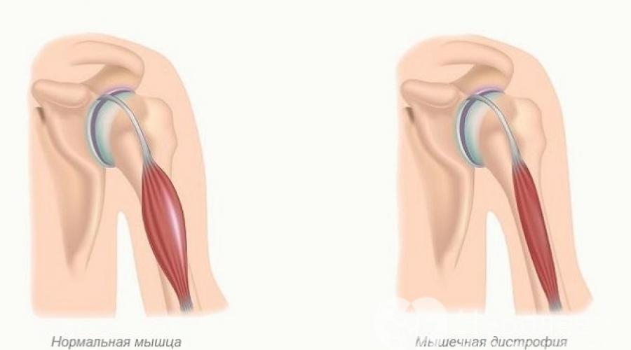 Дистрофия дюшенна. Атония мышц. Дистальная мышечная дистрофия.