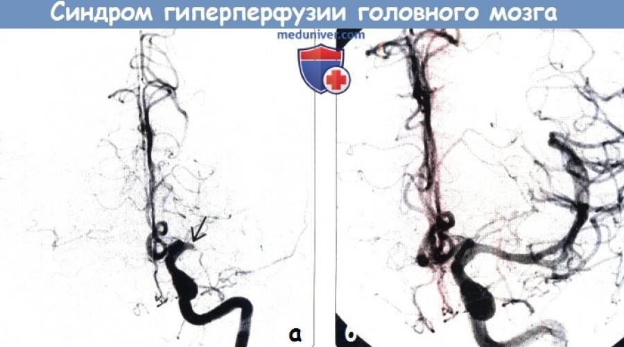 Гипоперфузия головного мозга при артериальной гипертензии. Некоторые аспекты лечебной тактики