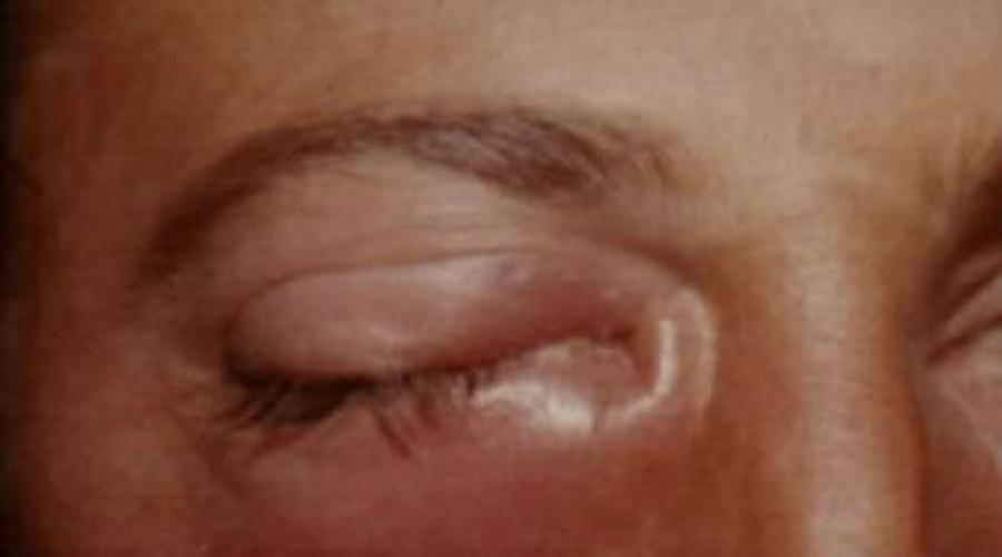 Конъюнктивальная гиперемия. Гиперемия конъюнктивы: причины, симптомы и лечение Конъюнктивит без покраснения глаз