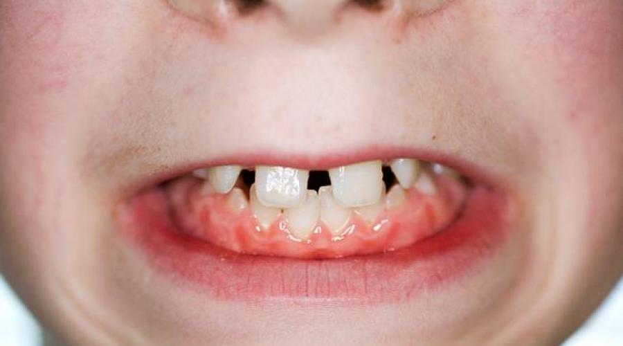 Почему ребенок во сне скрипит зубами: причины скрежета зубов у детей. Ребенок скрипит зубами во сне – причины и лечение детского бруксизма Ребенку 9 лет цокает во сне
