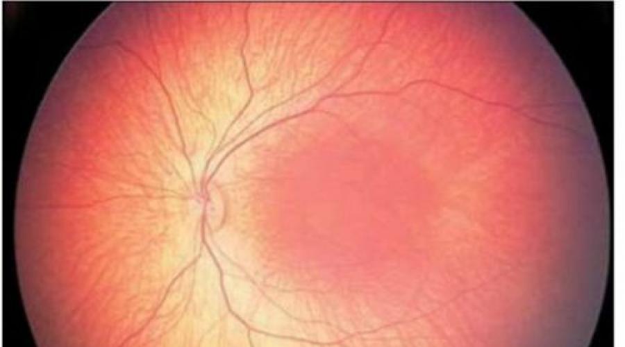 Осмотр глазного дна как называется. Как проводится офтальмоскопия — исследование глазного дна диагностической линзой