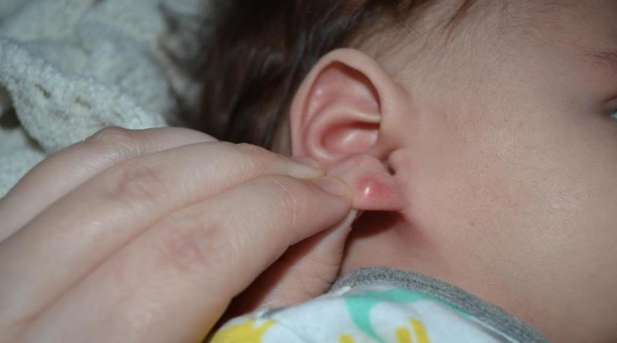 Шишка на мочке уха – чем лечить, как избавиться от уплотнения. Как удалить шарик в мочке уха в домашних условиях