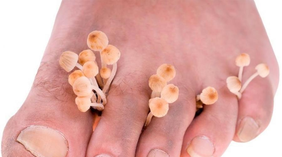 От чего лопается кожа на пальцах ног. Трещина на пальцах ног — лечение дома