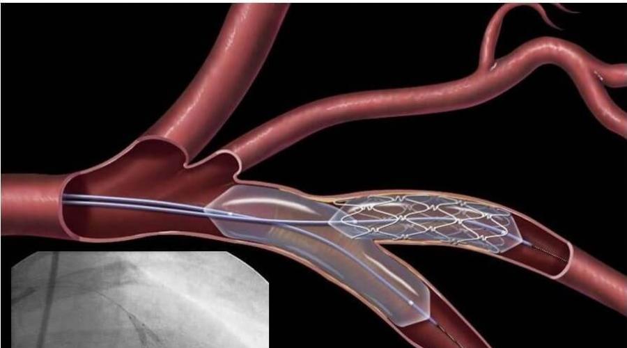 Операция по стентированию сосудов сердца (коронарных артерий): суть, стоимость, результат. Стентирование сосудов