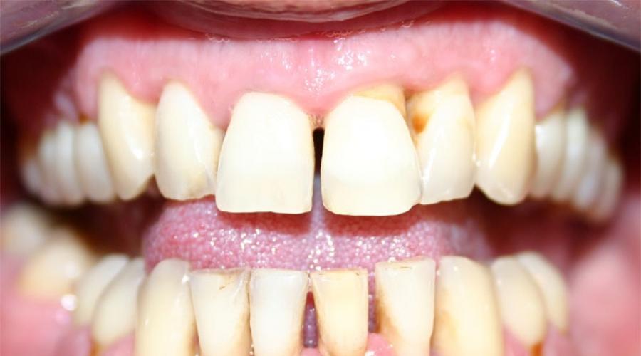 Воспаление десен вокруг зуба – чем лечить у взрослых и детей. Воспаление десны: лечение, симптомы