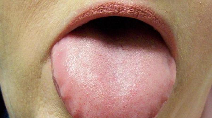 Опух корень языка. Причины появления опухшего языка