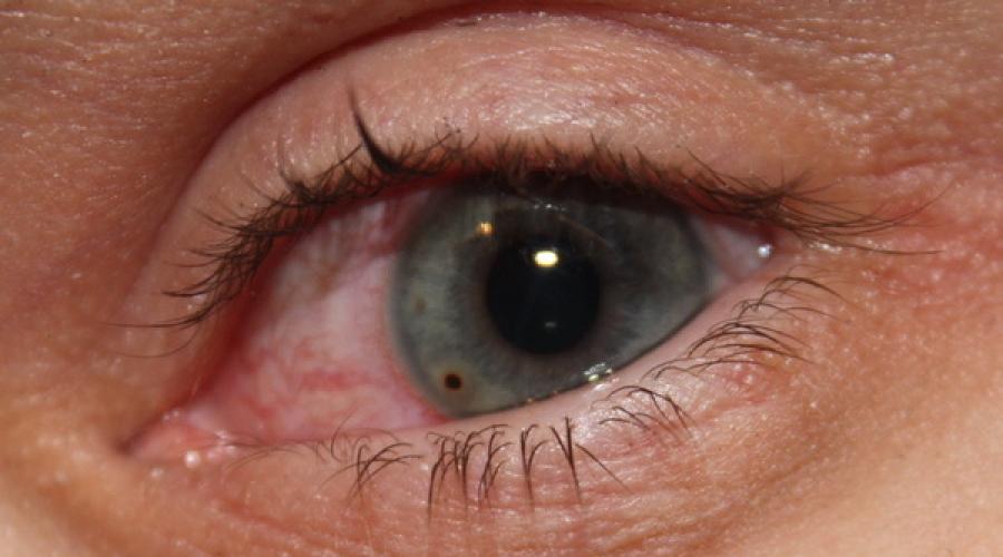 Инородное тело в глазу диагностика. Осложнения прободных ранений глазного яблока