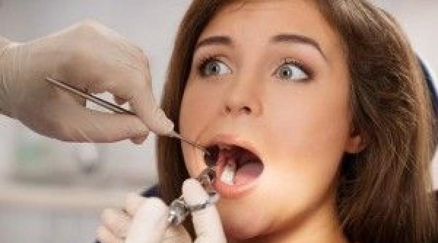 Анальгетики в стоматологии. Виды анестезии при лечении зубов: какие анестетики и обезболивающие препараты используются в стоматологии? Проведение внутрикостной анестезии