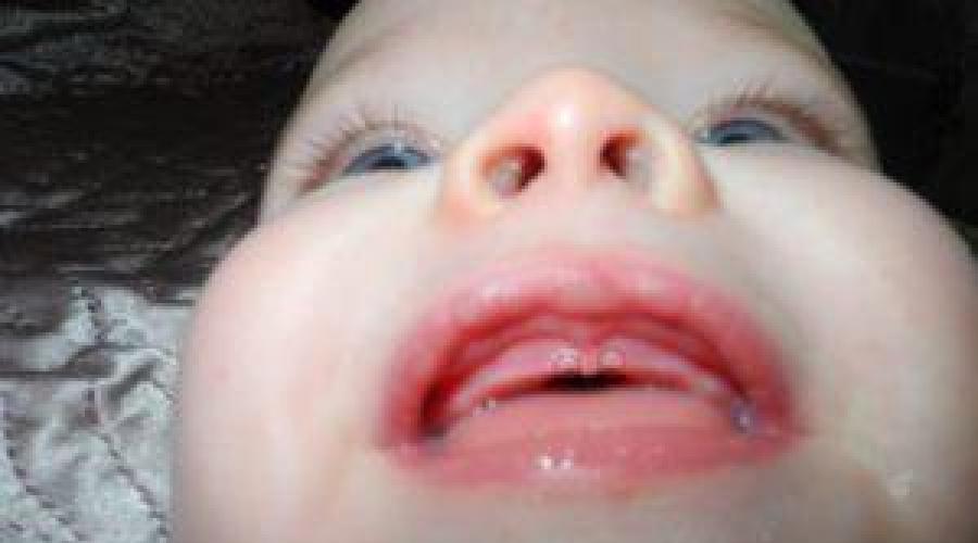 Во сколько лезут первые зубки. Когда режутся зубки у ребенка: симптомы и что делать