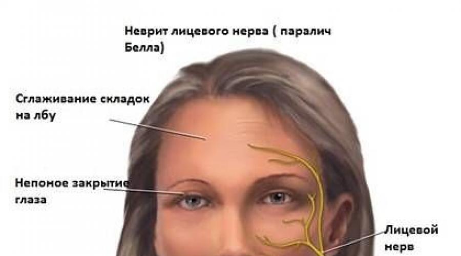 Воспаление лицевого нерва фото симптомы и лечение