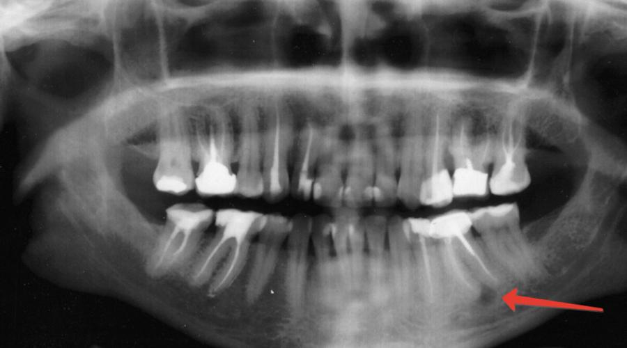 Как определить кисту в зубе. Киста на корне зуба — лечение или удаление