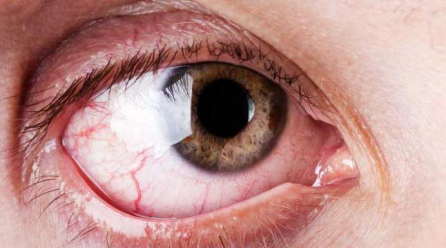 Гиперемия конъюнктивы глаз. Гиперемия глаз: причины и лечение