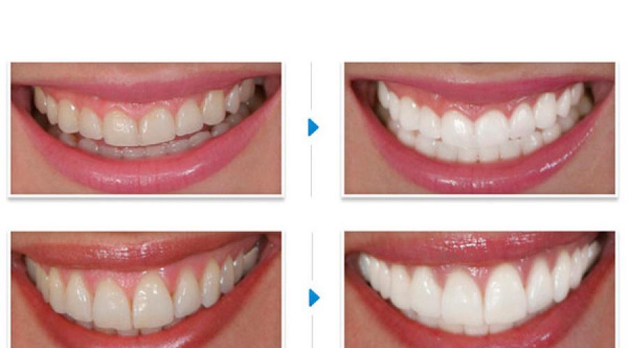 Хорошие средства для отбеливания зубов. Эффективные препараты и способы отбеливания зубов