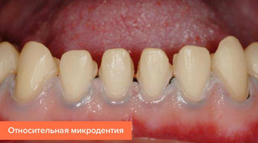 Мелкие зубы у человека. Что можно узнать по состоянию зубов человека? Определяем характер по зубам