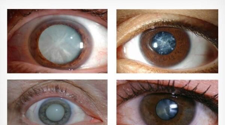 Причины, симптомы и профилактика катаракты, глазные капли. Мутный глаз у человека, зрачок и хрусталик – почему Больные катарактой