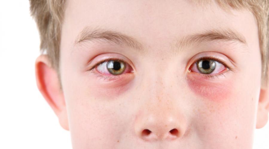 Почему ребенок стал моргать глазами и часто щуриться: причины и лечение. Когда ребенок щурит глаза Щуриться и моргает