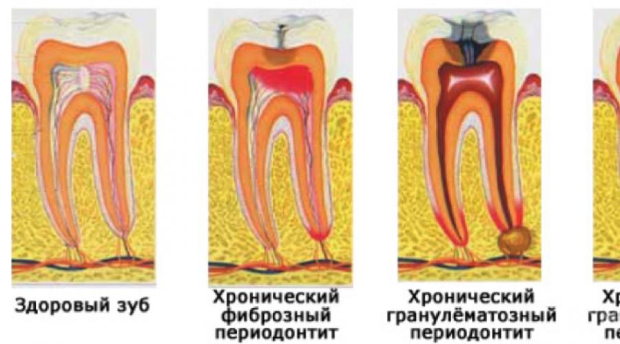 Периодонтит: симптомы и лечение, фото и диагностика. Периодонтит: лечение, симптомы, осложнения Ли периодонтит