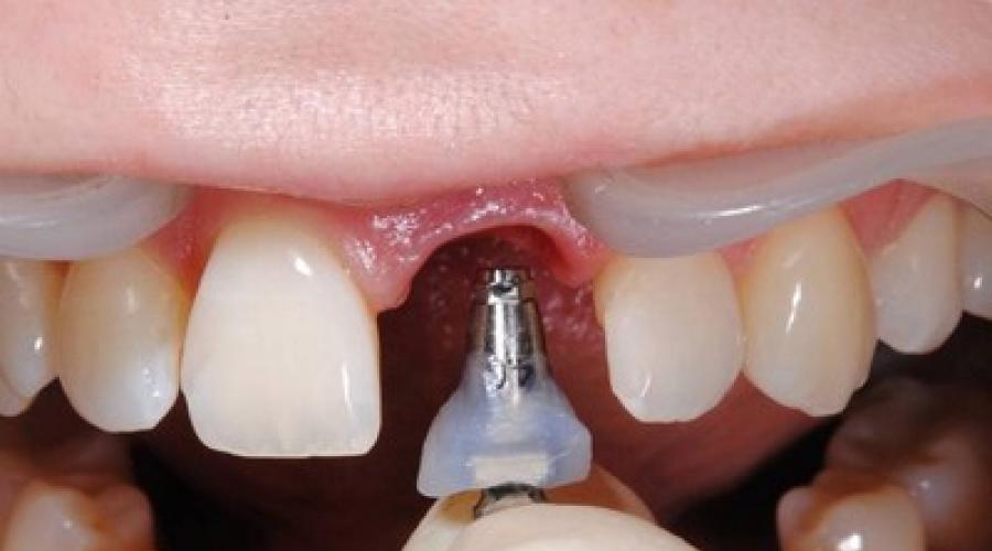 Имплант зуба процесс. Процесс имплантации зубов по этапам