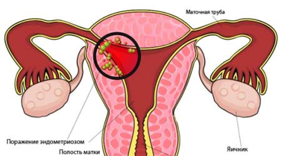 Как лечат эндометриоз матки? Эндометриоз матки: что это и как обезопасить себя от этого заболевания. Причины возникновения эндометриоза у женщин