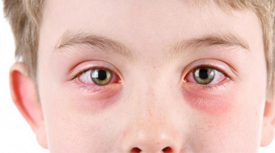 Какие заболевания глаз бывают у детей. Болезни глаз у детей — причины и симптомы и фото