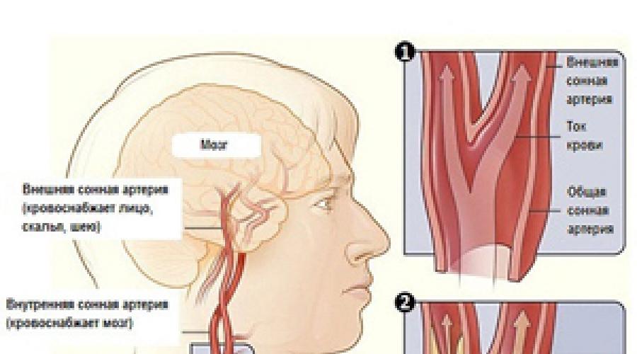 Спазм сосудов мозга. Спазмирование сосудов головы. Вазоспазм сосудов головного. Дуплекс бца головы и шеи.