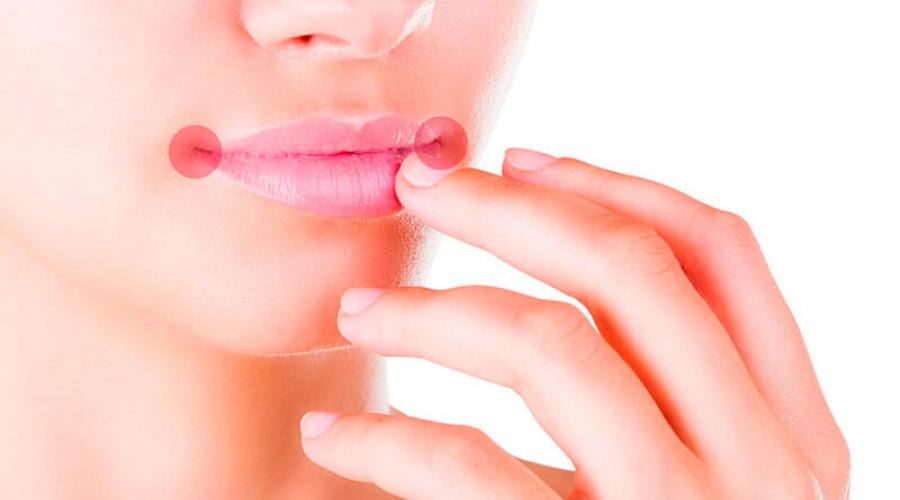 Заеды в уголках рта: причины, симптомы и лечение у взрослых. Заеды на губах: причины и лечение